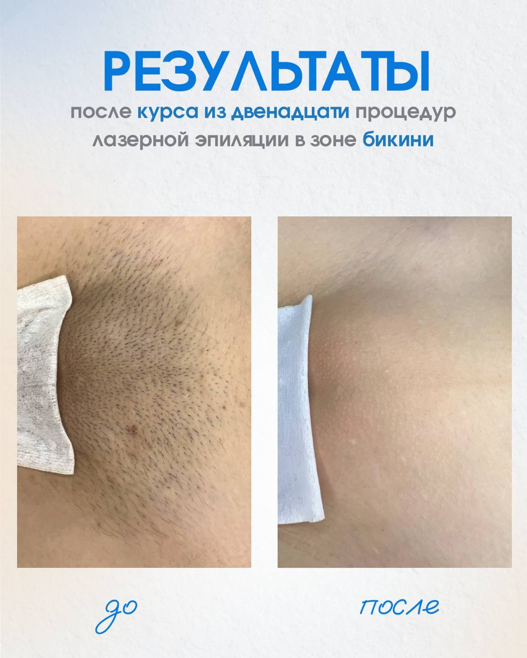 До и после курса из двенадцати процедур лазерной эпиляции в зоне бикини