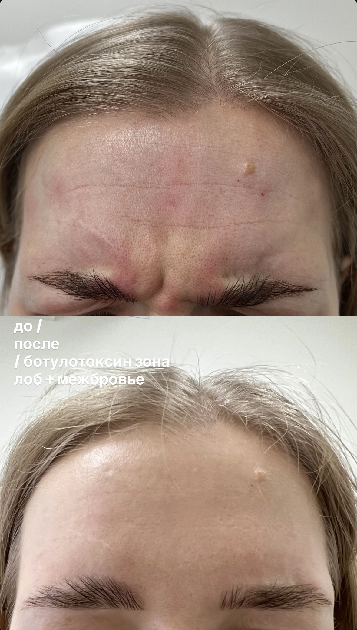 Ботулотоксин