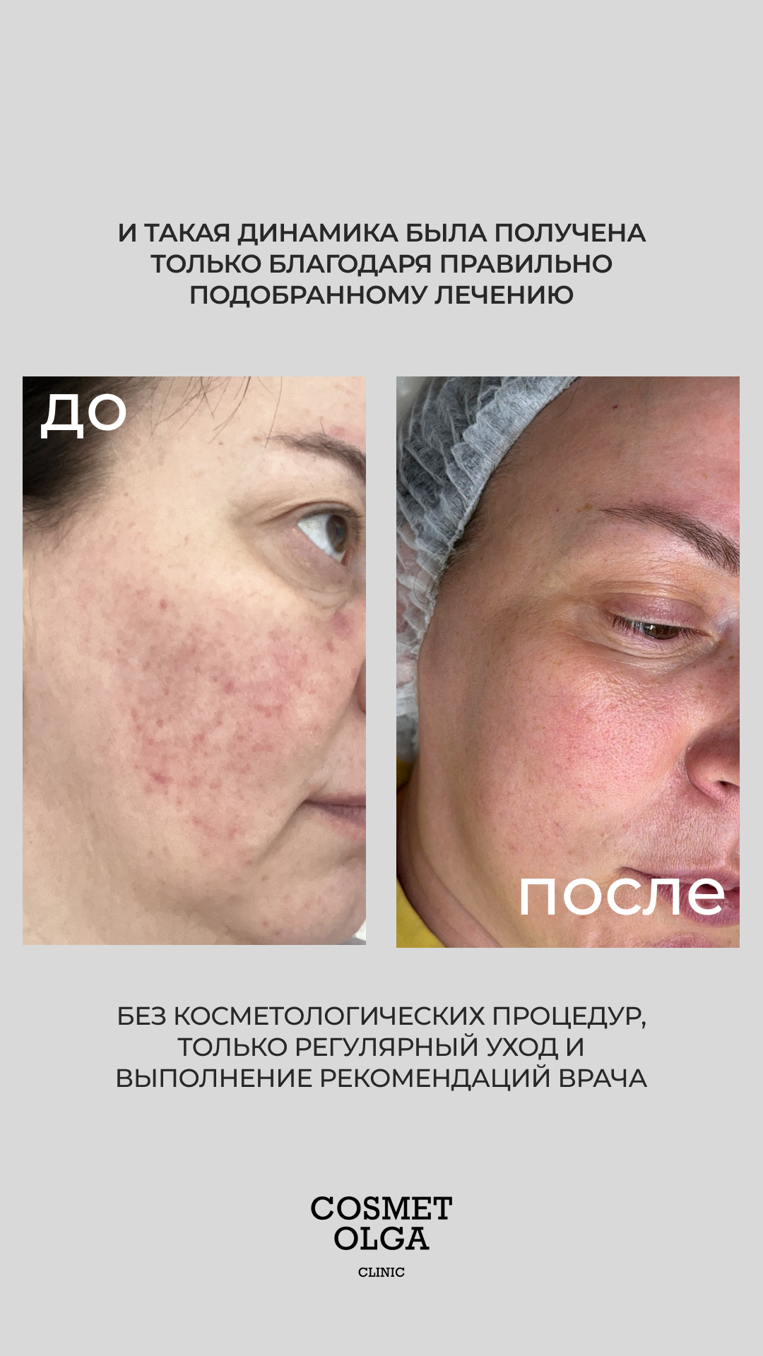 Акне и качество кожи