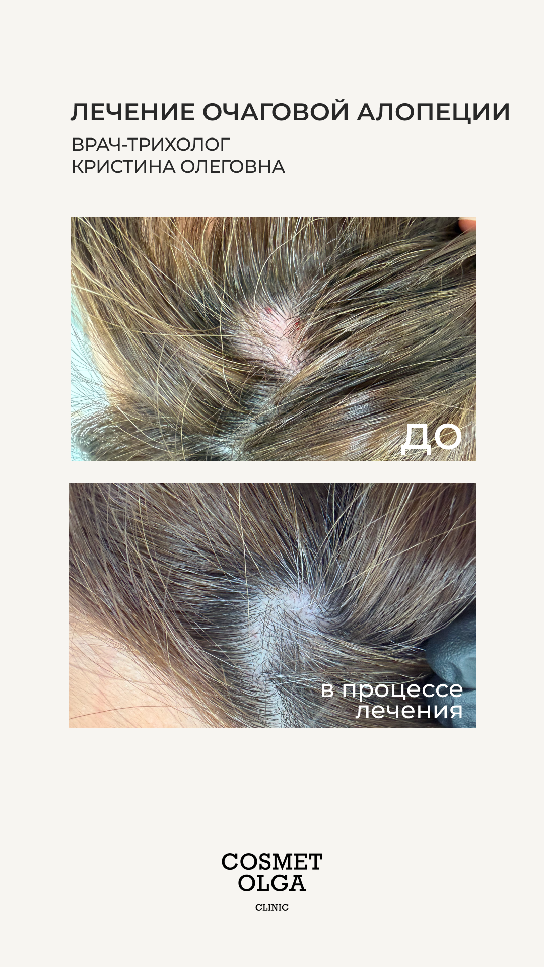 Ботулотоксин