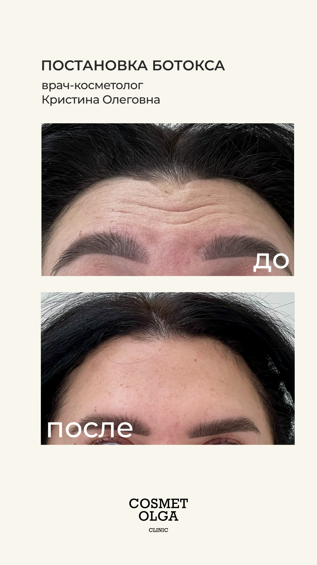 Ботулотоксин
