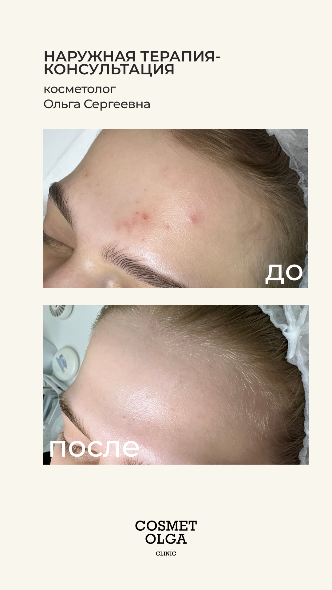 Акне и качество кожи
