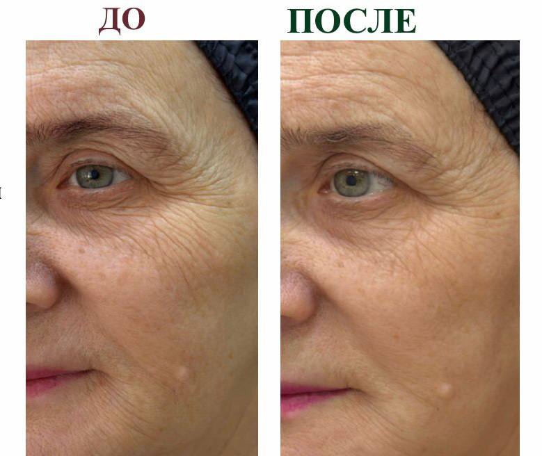 Фото до и после, пациентка 69 лет