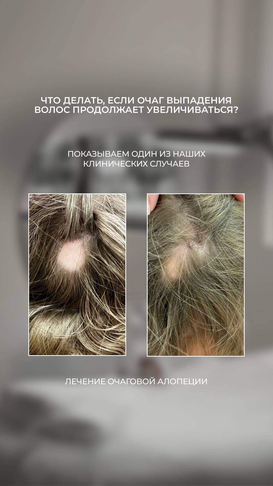 Ботулотоксин