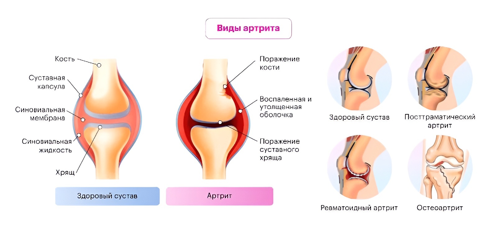 Артрит: когда возникает воспаление суставов, причины, симптомы, лечение.
