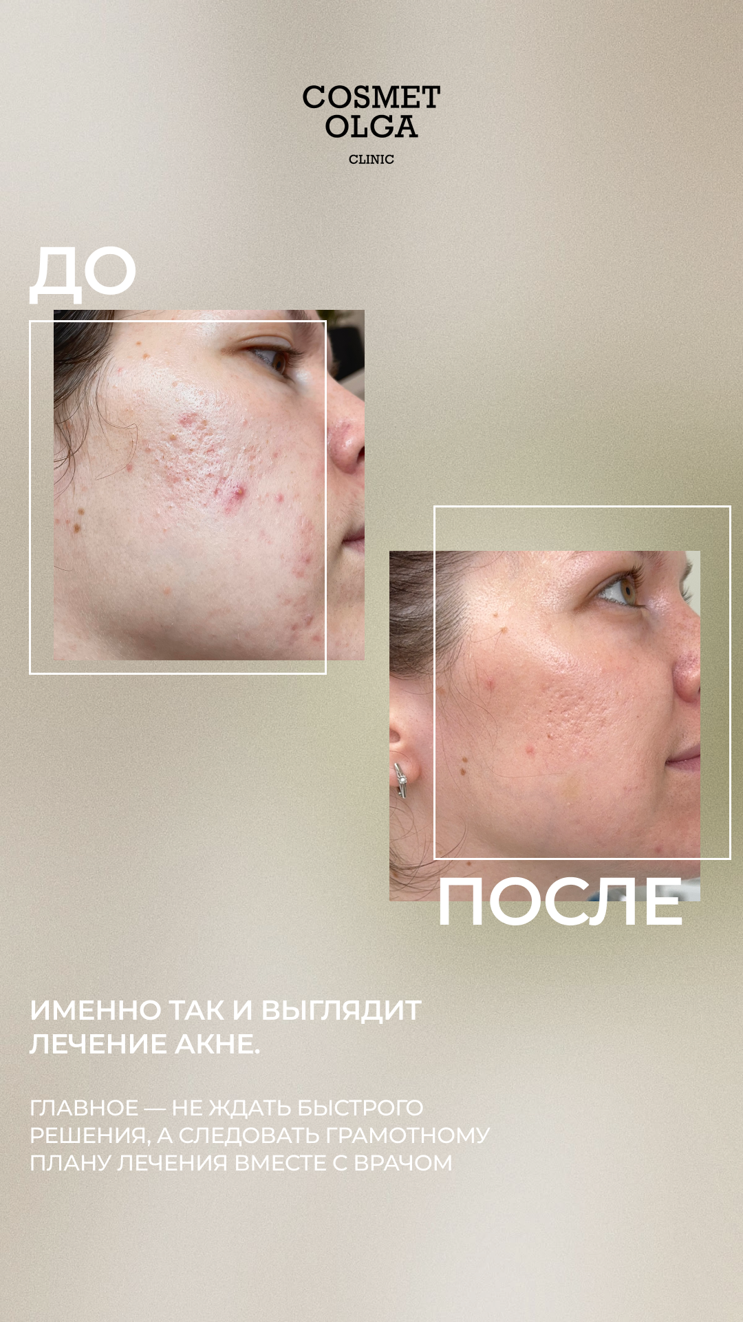 Акне и качество кожи