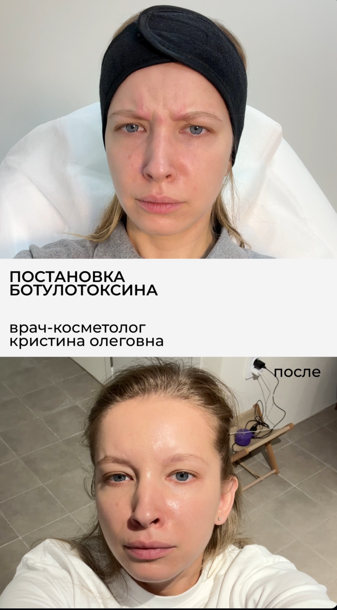 Ботулотоксин