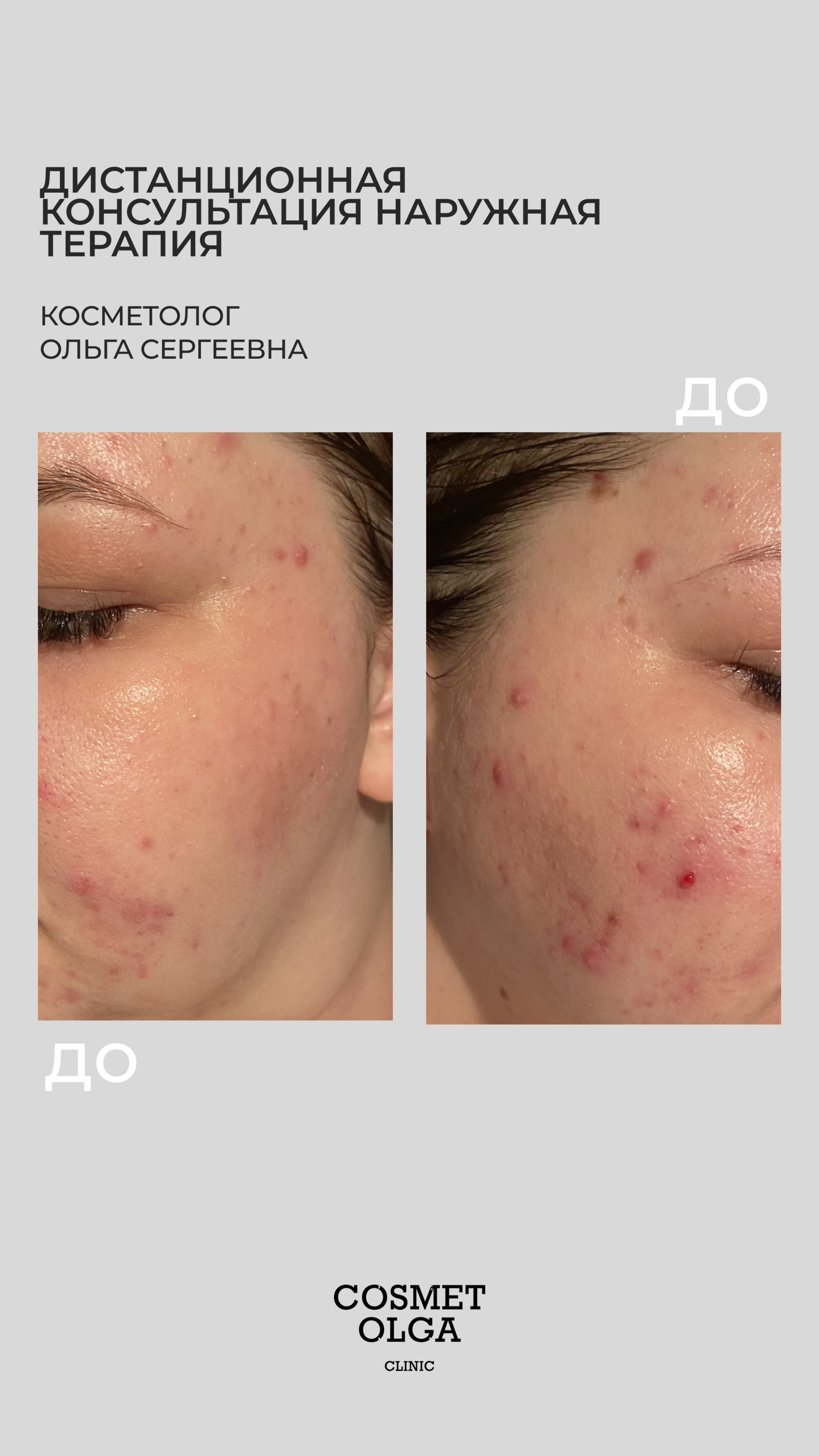 Акне и качество кожи