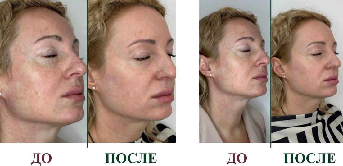 Фото до и после, пациентка 40 лет